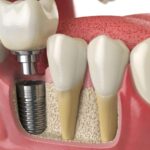 najbolji-zubmi-implantati