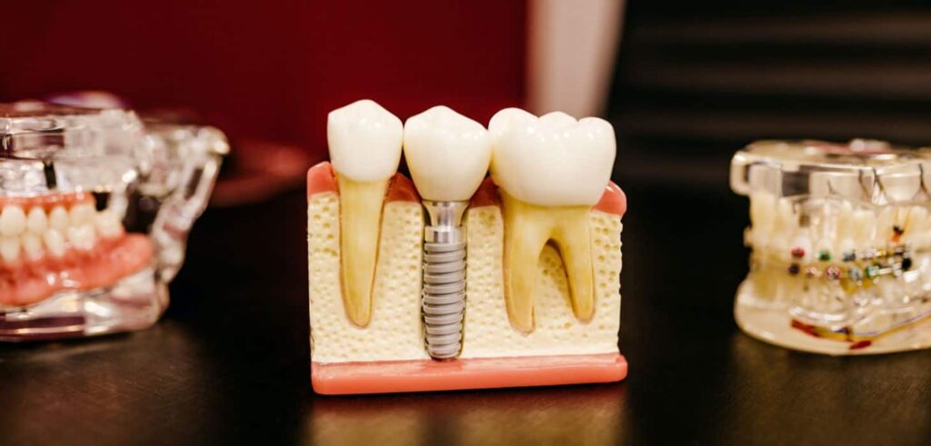 Vrste zubnih implantata