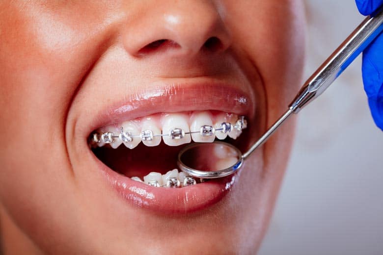 zubni aparatic pregled