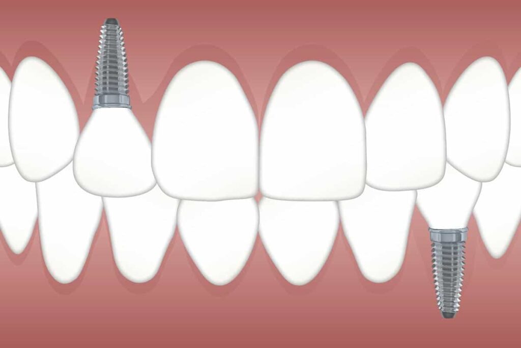 zubni-implantati